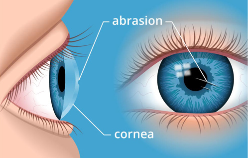 cornea