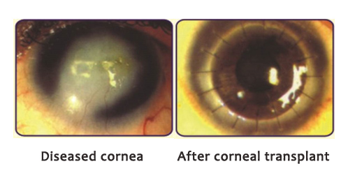 cornea